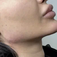 پکیج مادلینگ ده سی سی امروز ۳۳۰۰ بوتاکس ژل لب