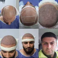 خدمات ژل وبوتاکس /کاشت مووابرو/باکمترین قیمت|خدمات آرایشگری و زیبایی|خرم‌آباد, |دیوار