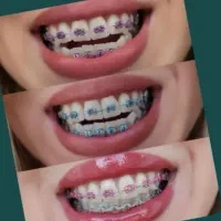 ارتودنسی اقساط ۱۸ ماهه