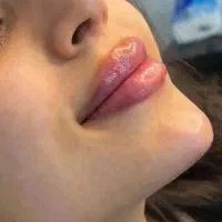 جشنواره تخفیفی خدمات زیبایی ( ژل بوتاکس و)