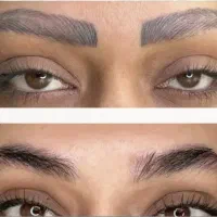 پاک کردن تضمینی تاتو در یک جلسه/ریموو تاتو