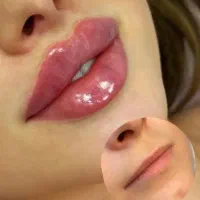 جشنواره پاییزه تزریق ژل و بوتاکس