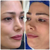 تنها یک روز فرصت باقی مانده برای بلفاروپلاستی