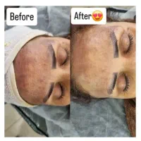 مزوندلینگ ،میکرونیلدینگ و درمان تخصصی لک|خدمات آرایشگری و زیبایی|بیرجند, |دیوار