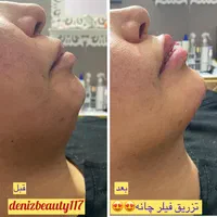 جشنواره تزریق ژل و بوتاکس (تحت نظرپزشک)|خدمات آرایشگری و زیبایی|اصفهان, خلجا|دیوار
