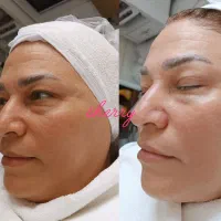 خدمات حرفه ای پاکسازی ریموو تتو و فیشال و جوانسازی|خدمات آرایشگری و زیبایی|هشتگرد, فاز ۱ مهستان|دیوار