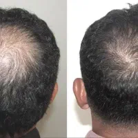 هنوز هم ماینوکسیدیل میزنی