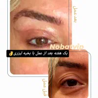 زیبایی پلک با بخیه به روش لیزری (بلفاروپلاستی)