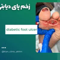 تونیک نانوحاوی کلوئیدنقره رفع زخم دیابتی وزخم بستر