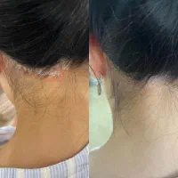 درمان دائمی بیماری پوستی خود ایمنی|خدمات آرایشگری و زیبایی|کوهنجان, |دیوار