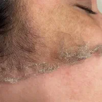 درما وپاکسازی روشن کننده پوست