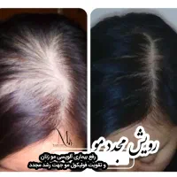 رفع ریزش و رویش ۱۰۰درصدی مو تضمینی
