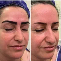 میکروکاشت ابرو 16 میلیون