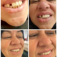 ساخت پروتز متحرک|آرایشی، بهداشتی، درمانی|آمل, |دیوار