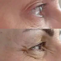 تخفیف بوتاکس و ژل|خدمات آرایشگری و زیبایی|دورود, |دیوار