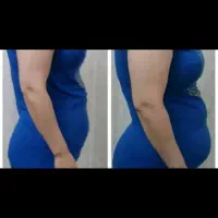 لاغری شکم تاعید(تضمینی)درکلینیک پزشکی(آفرعیدانه)