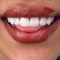 آفر ویژه کامپوزیت دندان