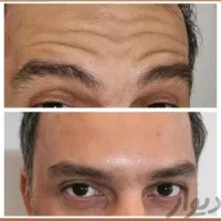 آموزش ژل و بوتاکس فیلر مزوتراپی تخفیف تا ۵۰ ٪