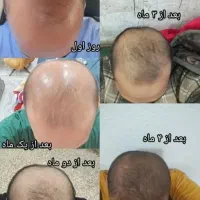 پک ریزش مو ورشد مجدد