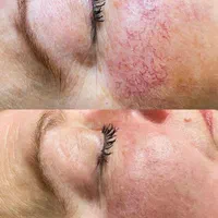 پاکسازی و فیشال صورت با تخفیف جشنواره تابستانه|خدمات آرایشگری و زیبایی|اراک, |دیوار
