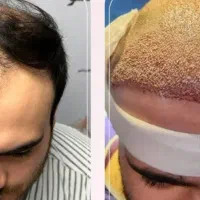 کاشت مو کاشت ابرو بلفارو و تخلیه غبقب