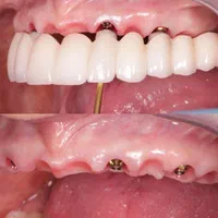 دندانپزشکی ایمپلنت کامپوزیت لمینیت روکش دندان|خدمات آرایشگری و زیبایی|تبریز, |دیوار