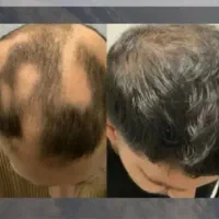 بازگشت موها بازگشت اعتماد به نفس پایان کم پشتی مو