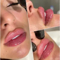 جشنواره تخفیف فیلر،بوتاکس،جوانساز در کلینیک زیبایی