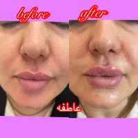 جشنواره فیلروبوتاکس مادلینگ‌صورت باتخفیف ویژه|خدمات آرایشگری و زیبایی|تهران, کوهک|دیوار