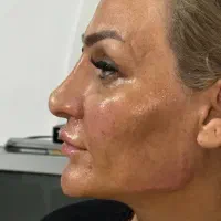 ساکشن چربی با بیهوشی و تزریق ژل و فیلر بادی و.|خدمات زیبایی و سلامت|کرمانشاه, |دیوار