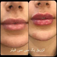 لیزر موهای زاید فیلر ژل بوتاکس مزو خال هایفو prp|خدمات آرایشگری و زیبایی|تبریز, |دیوار