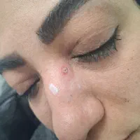 برداشتن انواع خال گوشتی و زگیل ومیکرونیدلینگ|خدمات آرایشگری و زیبایی|قم, انصار‌الحسین|دیوار