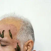 حجامت زالو بادکش