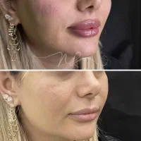 کلینیک تخصصی فرسیما/لیفت نخ/کانتورینگ/فیلر/بوتاکس