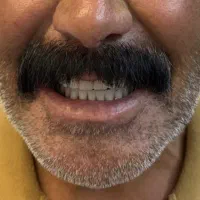 دندان مصنوعی اقساط بیمه