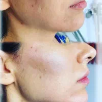 ، تزریق ژل فیلر بوتاکس مزو فیلر بادی..|خدمات آرایشگری و زیبایی|شیراز, فضل‌آباد|دیوار