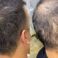 PRP ممنوع|آرایشی، بهداشتی، درمانی|مرند, |دیوار