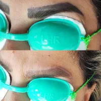 ریموو تتو و رفع تیرگی بدن در مطب پزشک|خدمات آرایشگری و زیبایی|آبادان, |دیوار