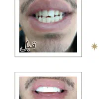 دندانپزشکی / کامپوزیت با تخفیف ویژه