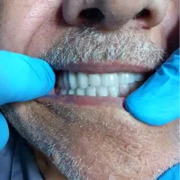 اموزش پروتز متحرک
