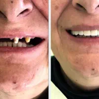 ایمپلنت/لمینت/کامپوزیت با قیمت ویژه وشرایط اقساط