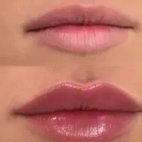 ژل و بوتاکس و چربی سوزی و پاکسازی