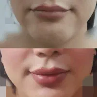 تزریق ژل و بوتاکس