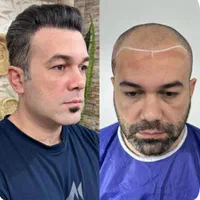 کاشت مووابرو با تخفیف درکلینیک تخصصی تبریز|خدمات آرایشگری و زیبایی|اردبیل, |دیوار