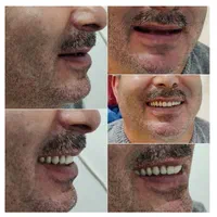 خدمات دندان مصنوعی (پروتز متحرک)|آرایشی، بهداشتی، درمانی|پارسآباد, |دیوار