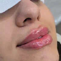 تزریق ژل و بوتاکس و زاویه