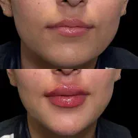 تزریق ژل چربی بوتاکس جوان ساز مزو پی آرپی|خدمات آرایشگری و زیبایی|رشت, گلسار|دیوار