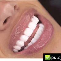 کامپوزیت دندان، روکش، دندانپزشکی تخصصی صدف تهرانسر|خدمات آرایشگری و زیبایی|تهران, تهرانسر مرکزی|دیوار