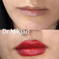 فیلر/بوتاکس/لب روسی/جوانساز/مزوژل مطب دکتر نیک جان