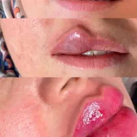 جشنواره یلدایی ژل بوتاکس پی ارپی فیلر بیکینی